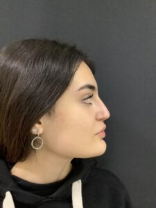 Nasolabial fold treatment in Madrid