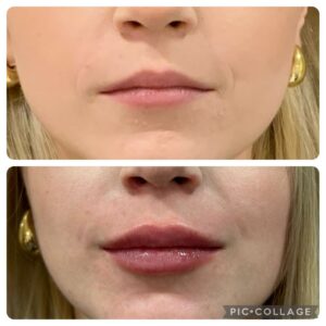 Neuromodulator Treatment in Madrid