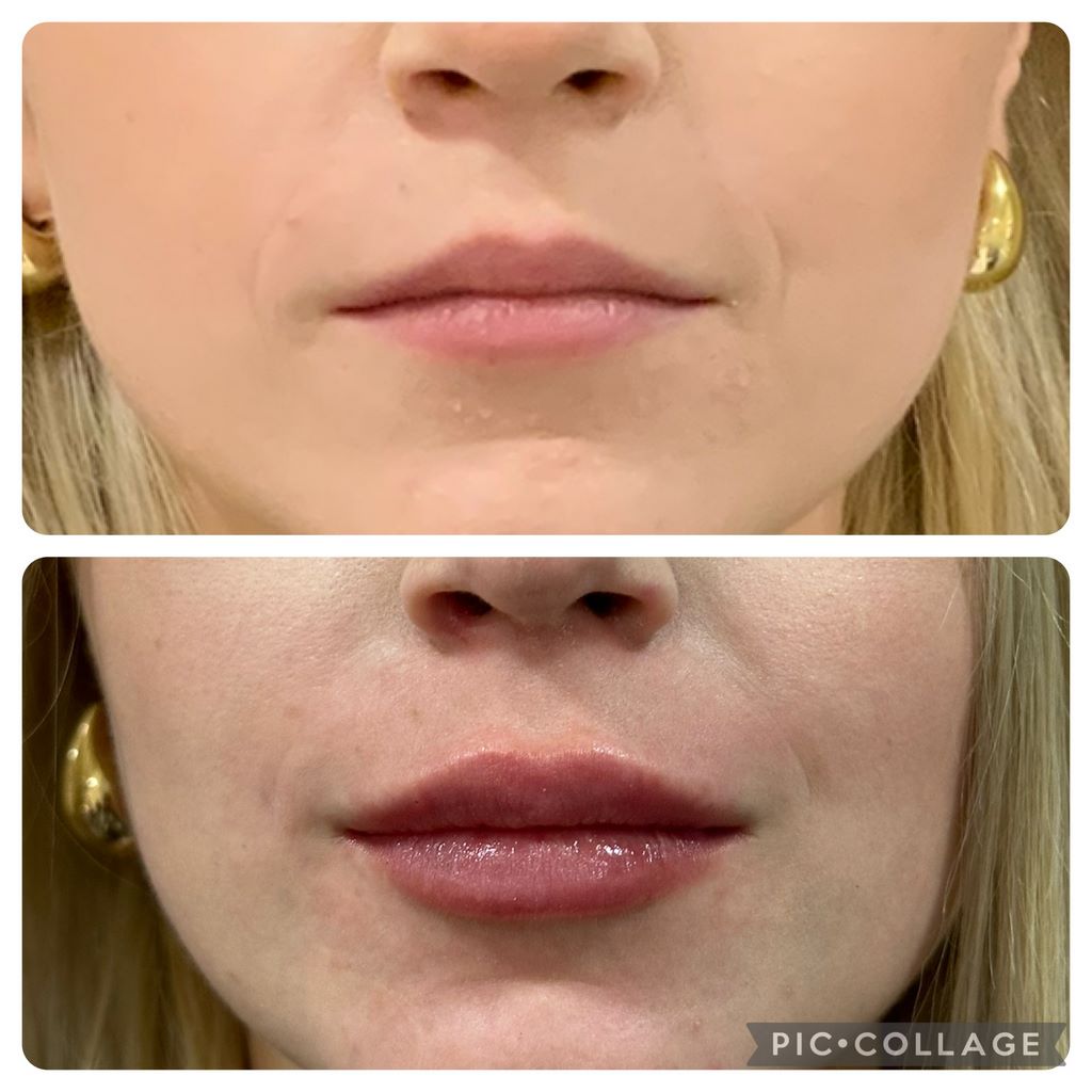 Neuromodulator Treatment in Madrid