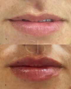 Lip Treatment in Madrid