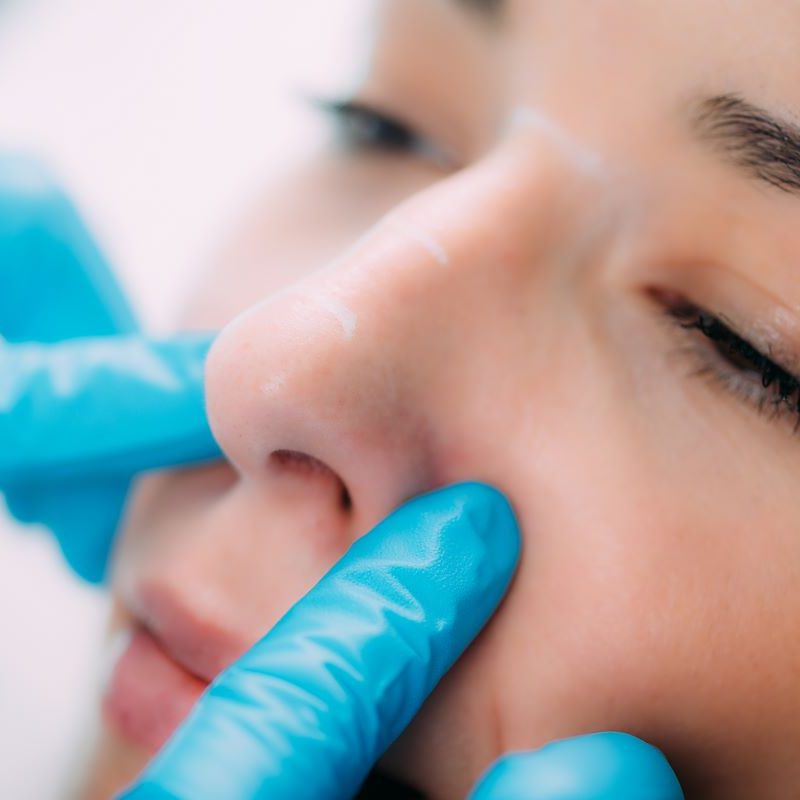 Dermal Fillers. Anti-Aging Treatment Doctor preparing a dermal filler for treatment of a woman’s nose.